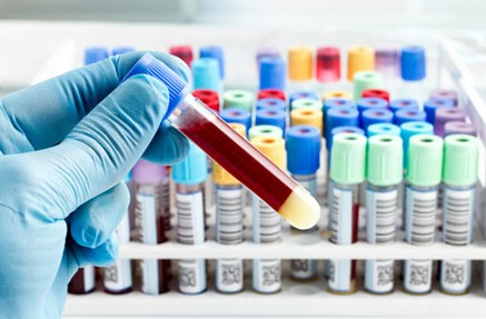 Glucose Metabolism Testing